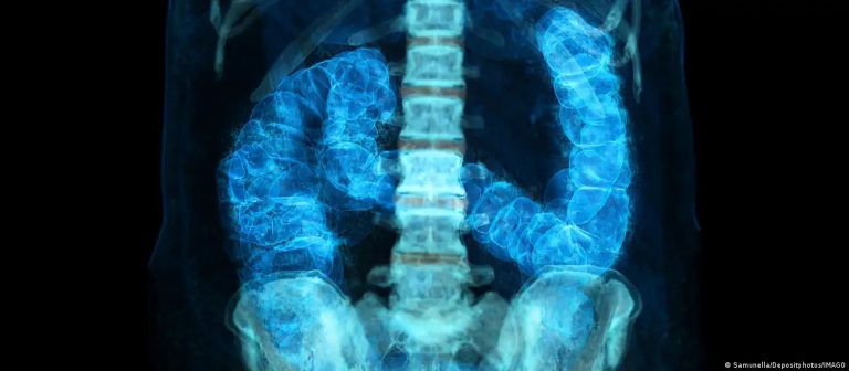 Cancer No Intestino Avanca Entre Americanos Menores De 50 Anos 768x336